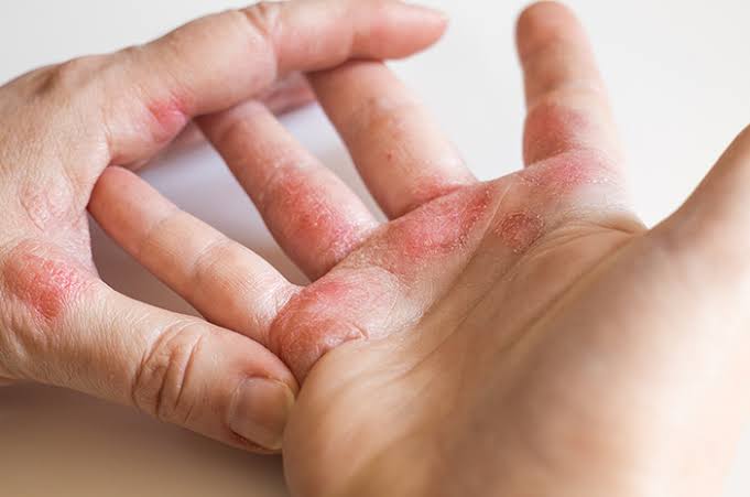 Kasus Kusta di kelompok anak paling banyak terjadi di Lingkup Keluarga